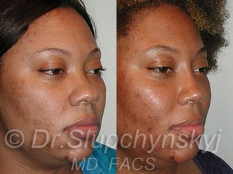 Ethnic Rhinoplasty 1117150
