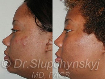 Ethnic Rhinoplasty after 1117150