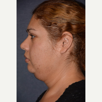 25-34 year old woman treated with Neck Lift before 3490141