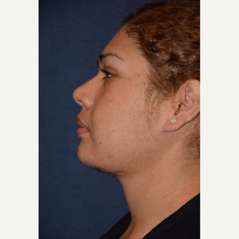 25-34 year old woman treated with Neck Lift after 3490141