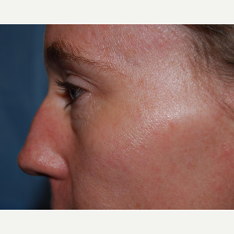35-44 year old woman treated with Eyelid Surgery before 3304773