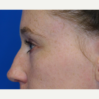 35-44 year old woman treated with Eyelid Surgery after 3304773