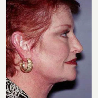 55-64 year old woman treated with Facelift after 3710268