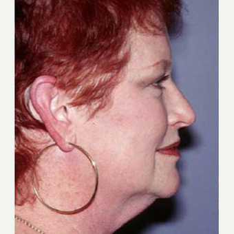 55-64 year old woman treated with Facelift before 3710268