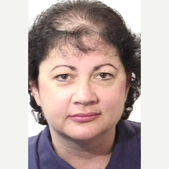 Hair Transplant before 3241465