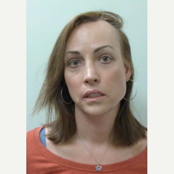 45-54 year old woman treated with Facial Feminization Surgery after 3135671