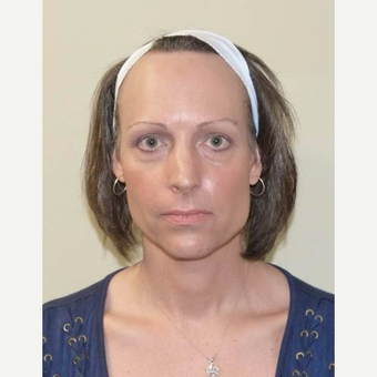 45-54 year old woman treated with Facial Feminization Surgery before 3135671