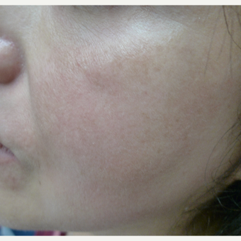 10 week melasma program after 3114376