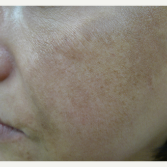 10 week melasma program before 3114376