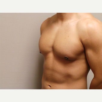 25-34 year old man treated with Male Breast Reduction after 3454673