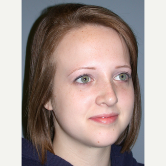 18-24 year old woman treated with Rhinoplasty after 3710460