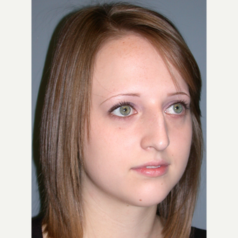 18-24 year old woman treated with Rhinoplasty before 3710460