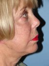 Facelift after 544795