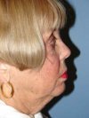 Facelift before 544795
