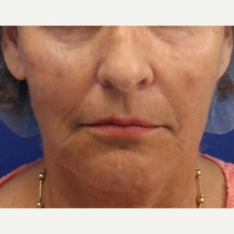 64 year old woman treated with Bellafill for mid face volume loss after 2120534
