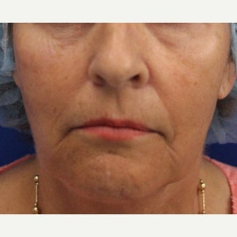 64 year old woman treated with Bellafill for mid face volume loss before 2120534