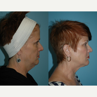 55-64 year old woman treated with Kybella before 3781864
