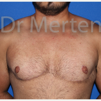 25-34 year old man treated with FTM Chest Masculinization Surgery after 3828968