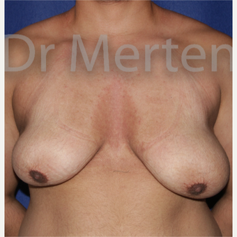 25-34 year old man treated with FTM Chest Masculinization Surgery before 3828968