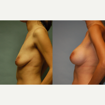 37 year old woman, 5'4", 108 lbs. Breast Augmentation 34 AA to C after 3420140