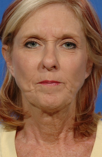 Facelift Revision of a 57 yr old woman before 2052785
