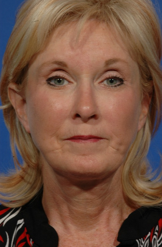 Facelift Revision of a 57 yr old woman after 2052785
