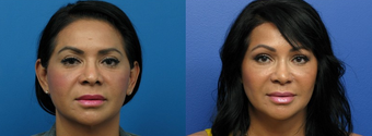 Facial Feminization Surgery before 2094729