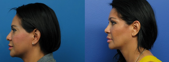Facial Feminization Surgery after 2094729