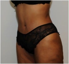 Abdominoplasty after 123630