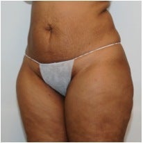 Abdominoplasty before 123630