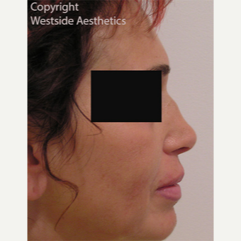 Non Surgical Bump Correction before 3004962