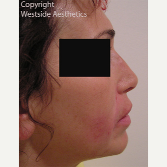 Non Surgical Bump Correction after 3004962