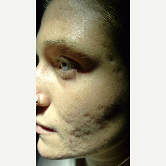 Multiple procedure for different scar types. before 3845574