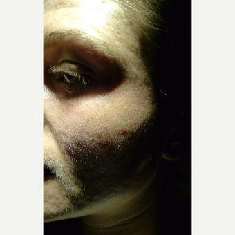 Multiple procedure for different scar types. after 3845574