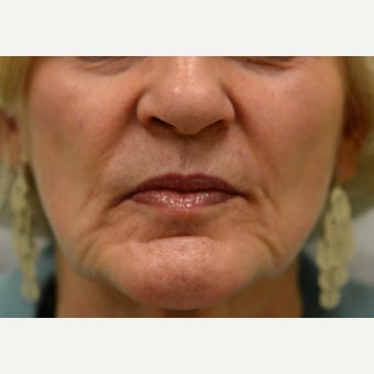 55-64 year old woman: Cheek and Peri-oral augmentation before 1715043