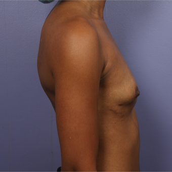 25-34 year old woman treated with Breast Augmentation before 3226376