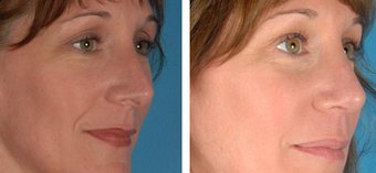 Revision Rhinoplasty before 1208288