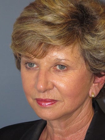 LiteLift™, Blepharoplasty, Brow Lift on 57-year-old Woman 1149643