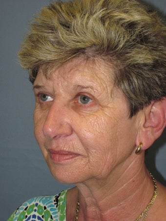 LiteLift™, Blepharoplasty, Brow Lift on 57-year-old Woman 1149643