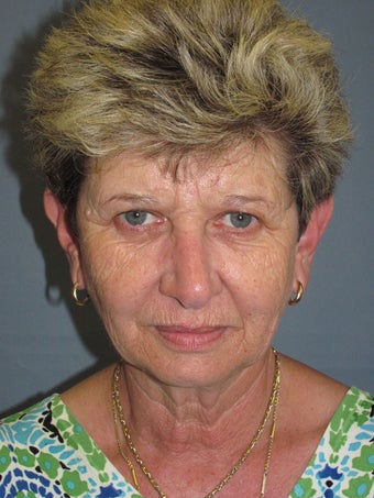 LiteLift™, Blepharoplasty, Brow Lift on 57-year-old Woman before 1149643