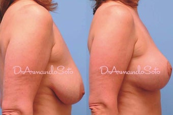 Mastopexy (Breast Lift) before 122903