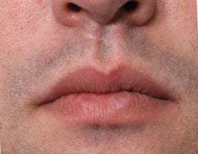 26 Year Old Treated For Large and Chapped Lips before 1108190