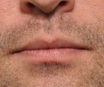 26 Year Old Treated For Large and Chapped Lips after 1108190