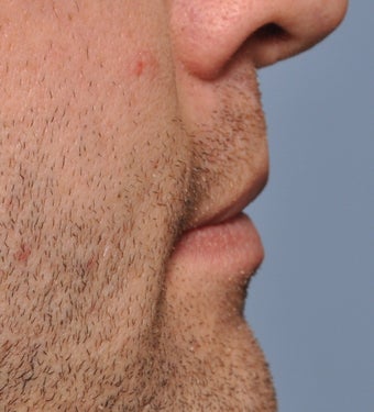 26 Year Old Treated For Large and Chapped Lips 1108190