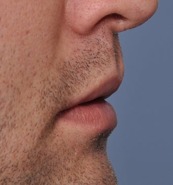 26 Year Old Treated For Large and Chapped Lips 1108190