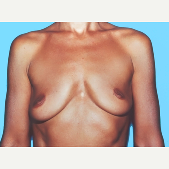 Breast Augmentation before 3732520