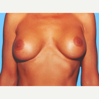 Breast Augmentation after 3732520