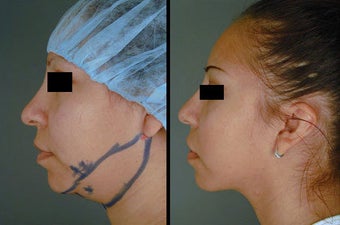 Chin/Neck Liposuction before 996360