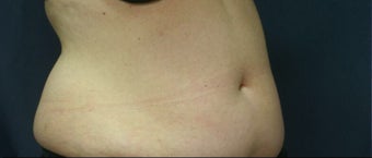 SculpSure treatment -8 weeks after one treatment before 3183035