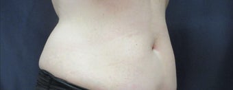 SculpSure treatment -8 weeks after one treatment after 3183035
